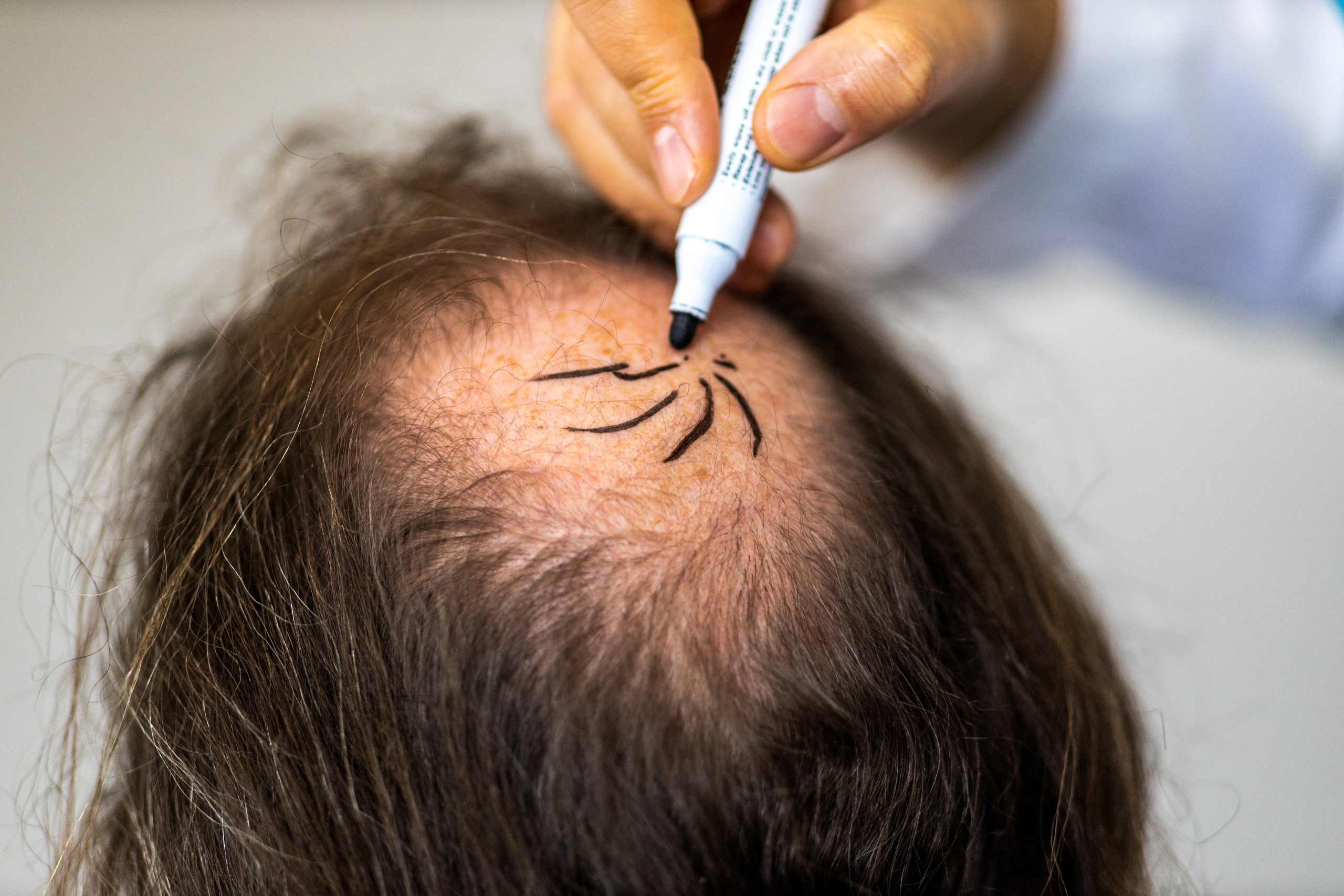 best hair transplant clinic in turkey